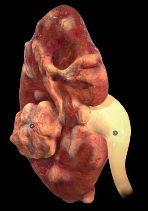 Renal Cell Carcinoma Low-poly 3D model_1