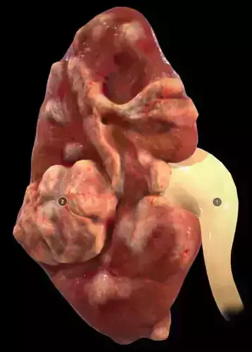 Renal Cell Carcinoma Low-poly 3D model