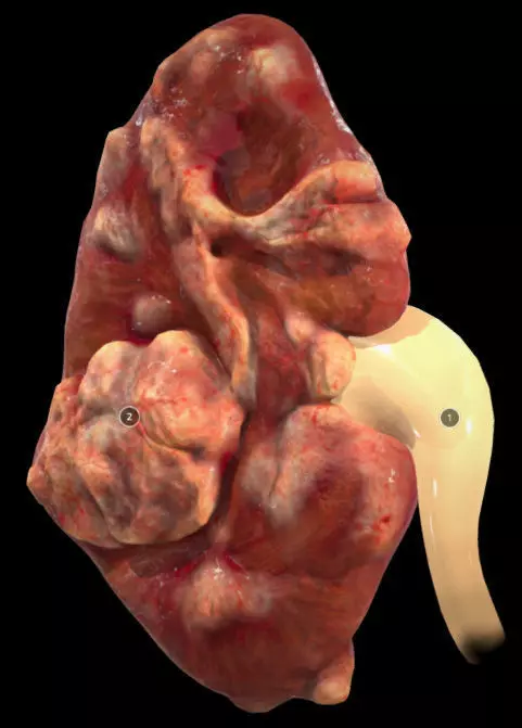 Renal Cell Carcinoma Low-poly 3D model_0