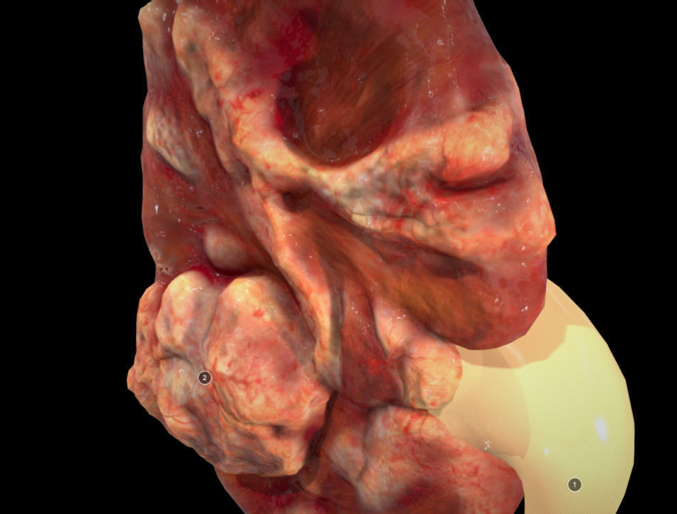 Renal Cell Carcinoma Low-poly 3D model_4