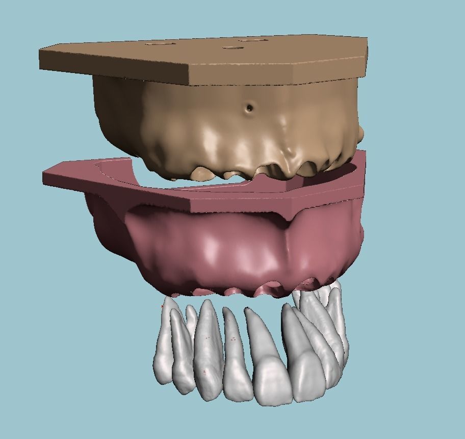 D011 Oral surgery and perio model 3D print model_17