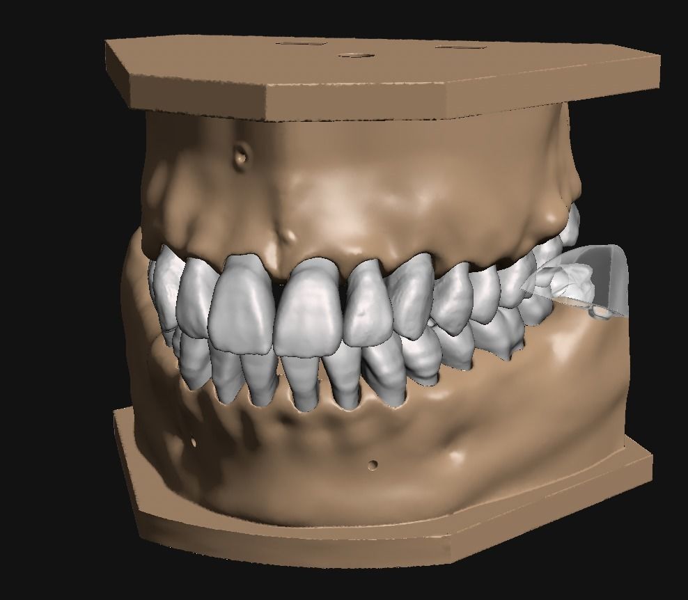 D011 Oral surgery and perio model 3D print model_11