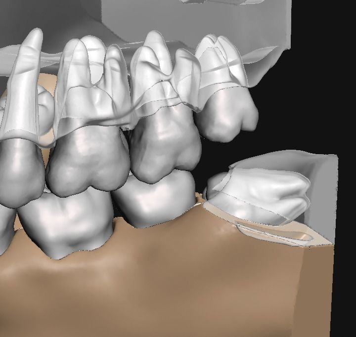 D011 Oral surgery and perio model 3D print model_7