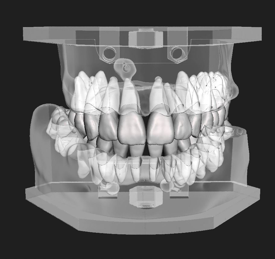 D011 Oral surgery and perio model 3D print model_18