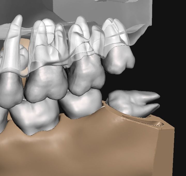 D011 Oral surgery and perio model 3D print model_3