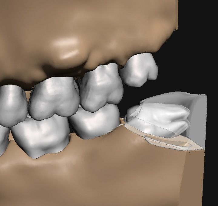 D011 Oral surgery and perio model 3D print model_9