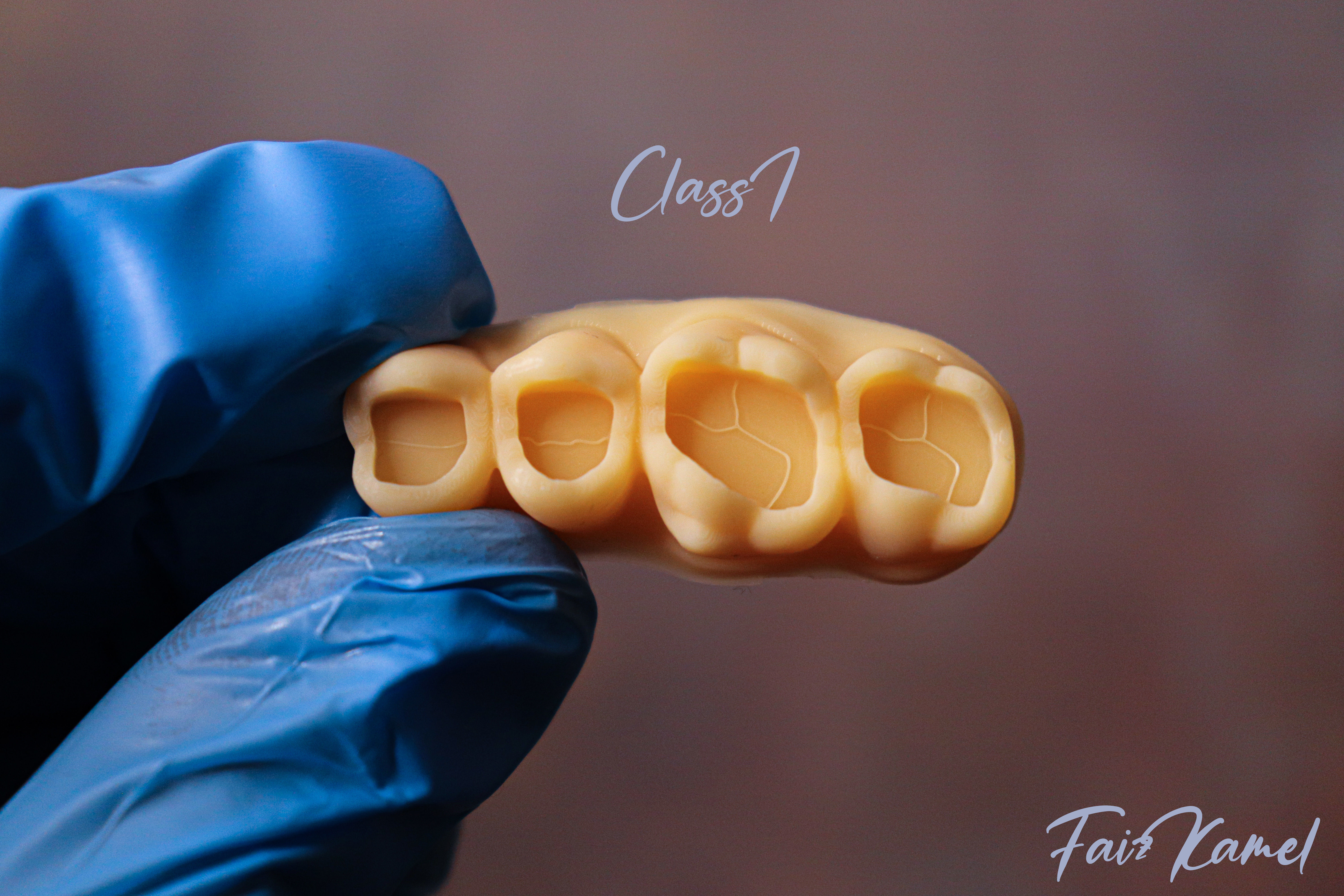 Dental Upper and Lower Arch Class 1 Models 3D print model_1