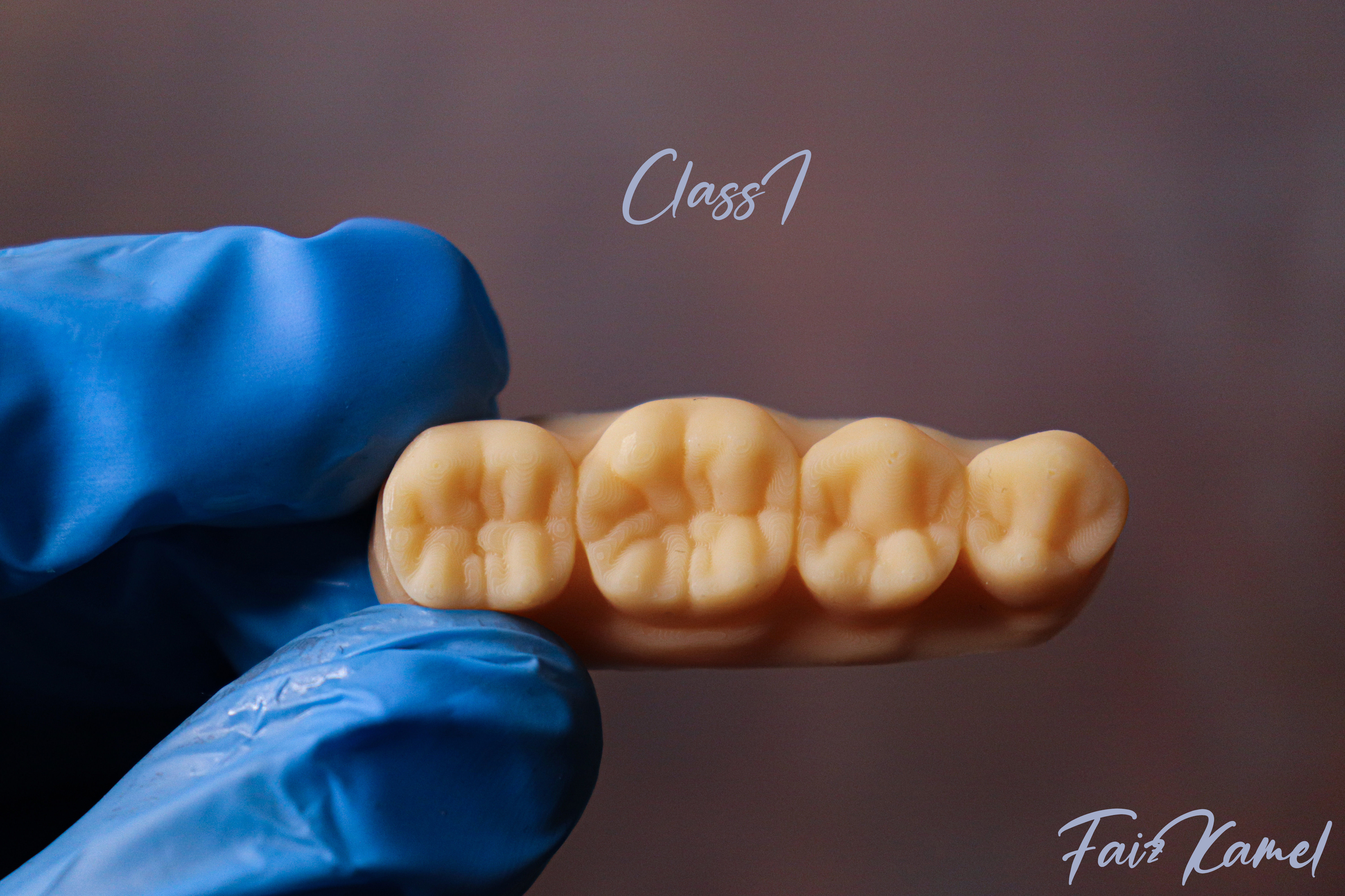 Dental Upper and Lower Arch Class 1 Models 3D print model_3