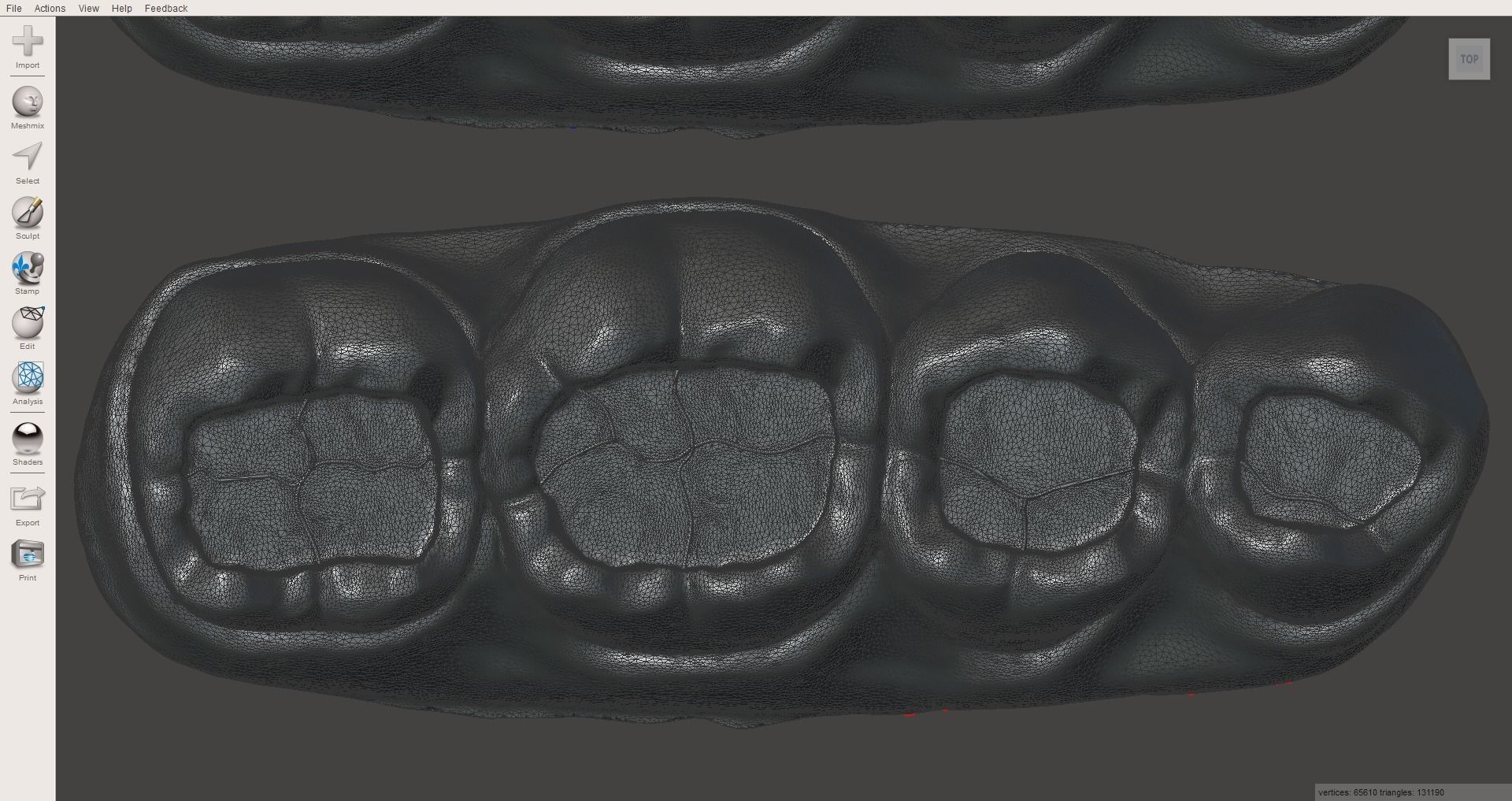 Dental Upper and Lower Arch Class 1 Models 3D print model_7