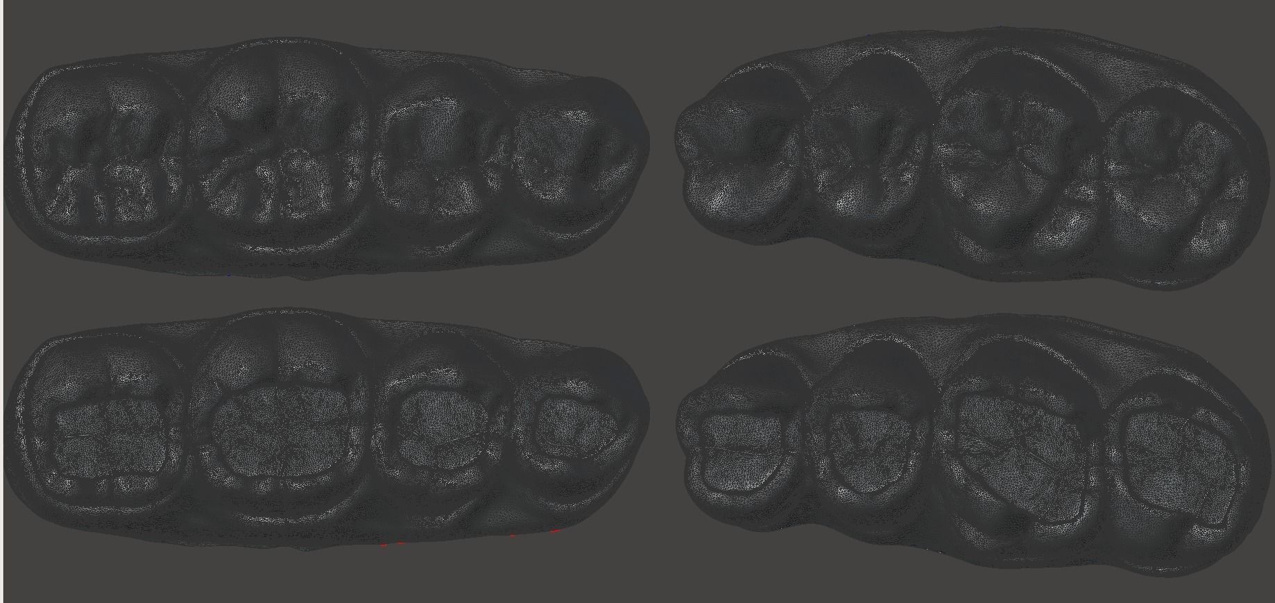Dental Upper and Lower Arch Class 1 Models 3D print model_8