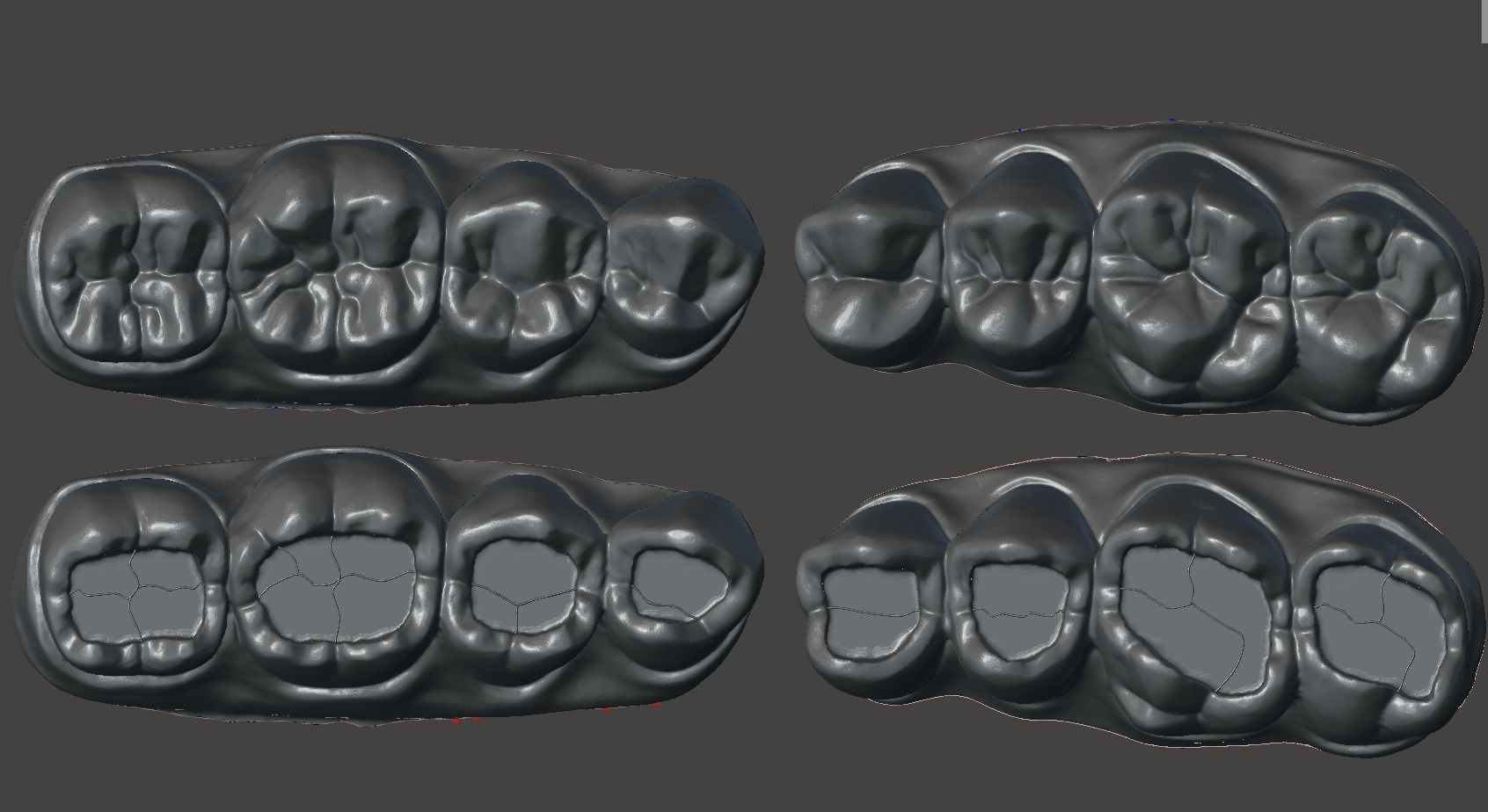 Dental Upper and Lower Arch Class 1 Models 3D print model_4