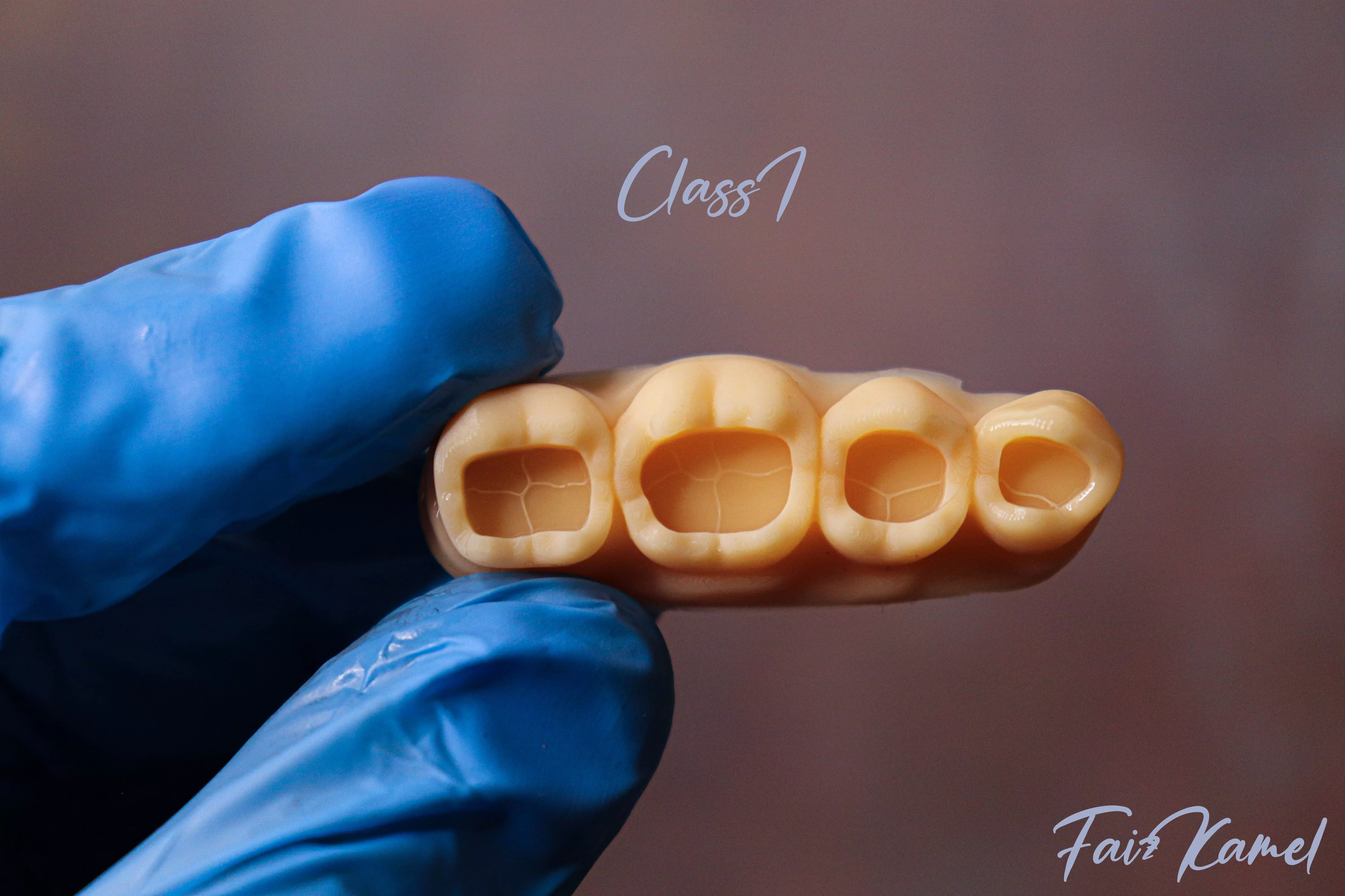 Dental Upper and Lower Arch Class 1 Models 3D print model_0