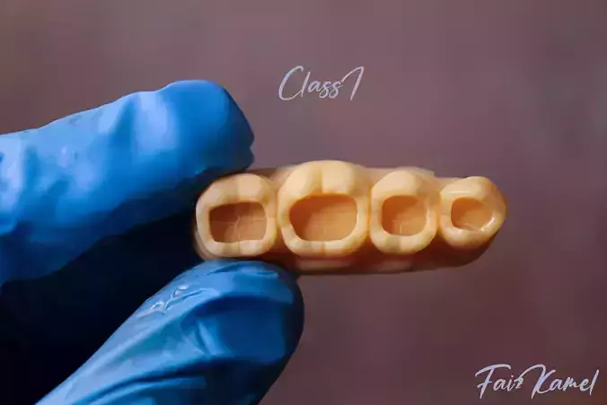 Dental Upper and Lower Arch Class 1 Models 3D print model