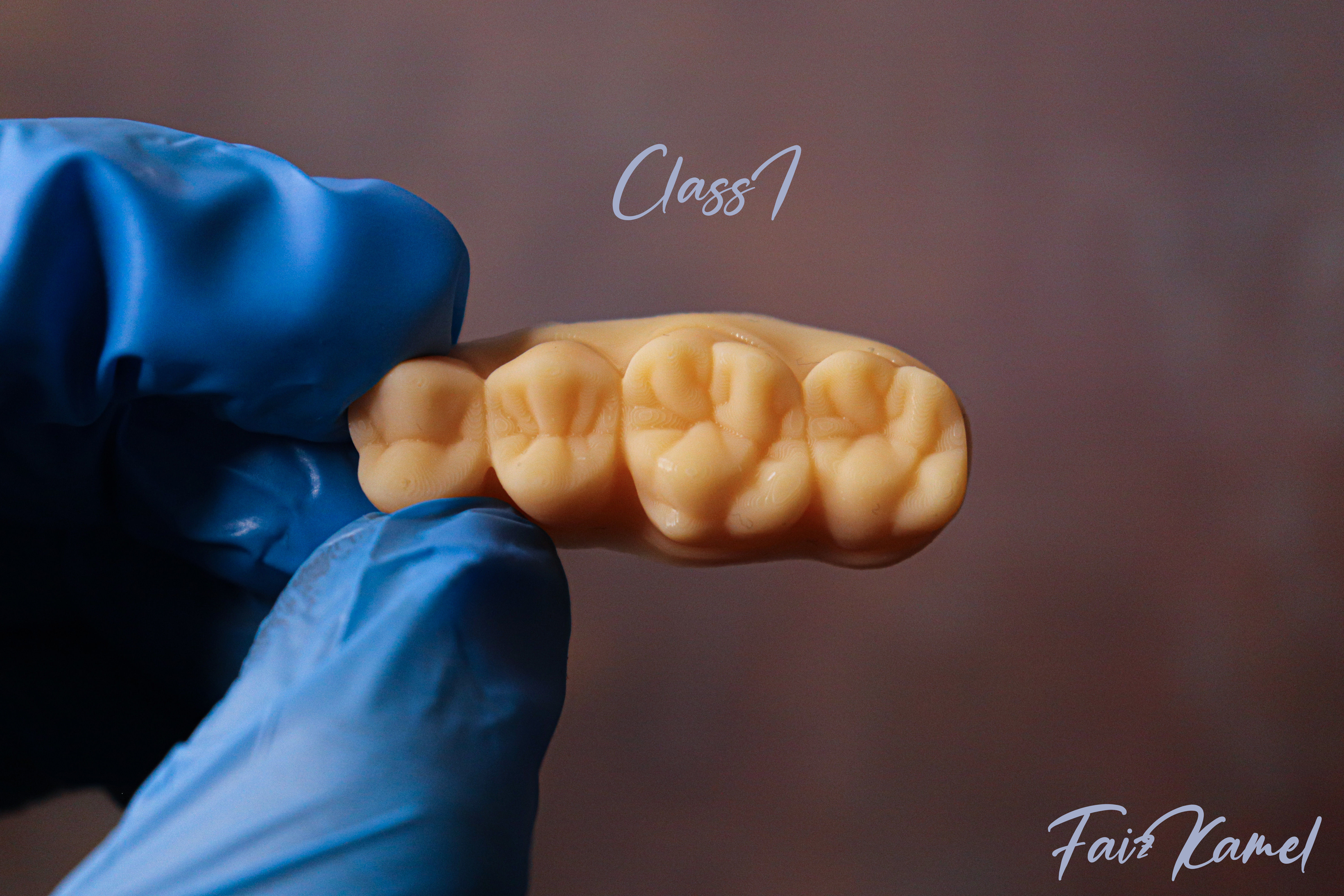 Dental Upper and Lower Arch Class 1 Models 3D print model_2