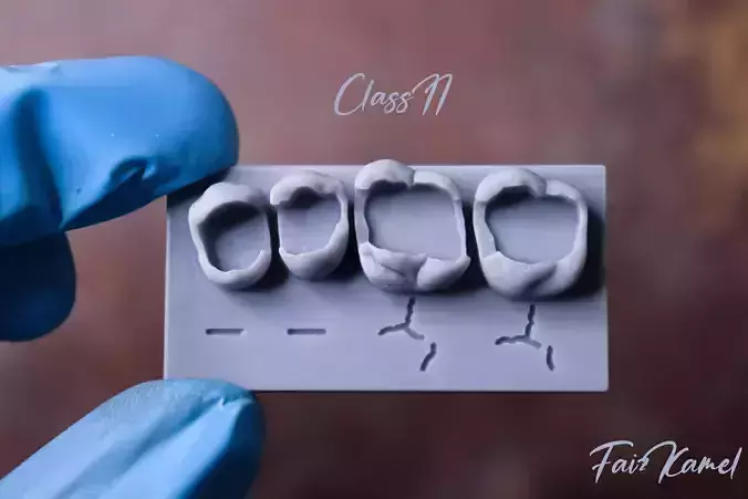 Dental Upper and Lower Arch Class 2 Models 3D print model