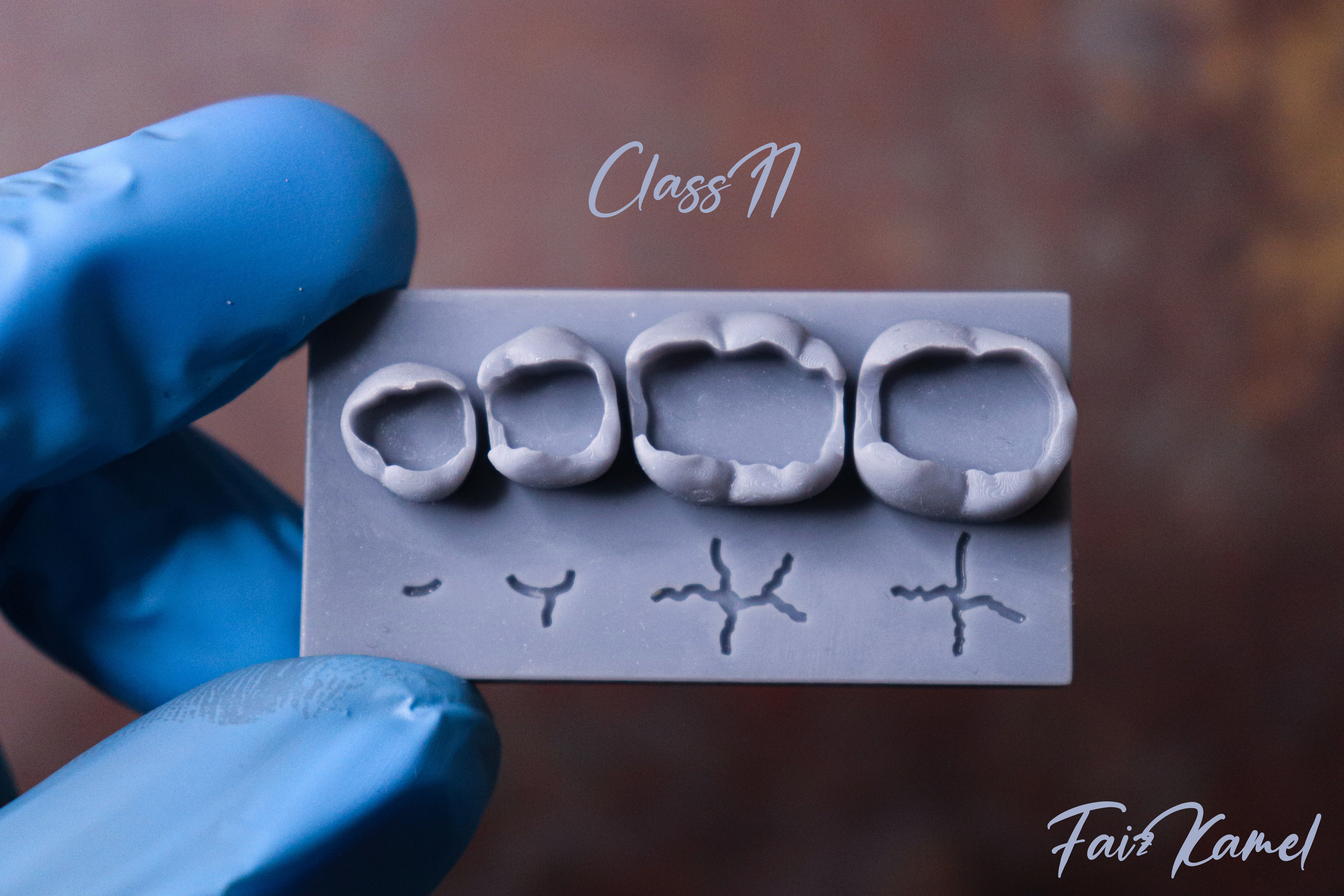 Dental Upper and Lower Arch Class 2 Models 3D print model_1