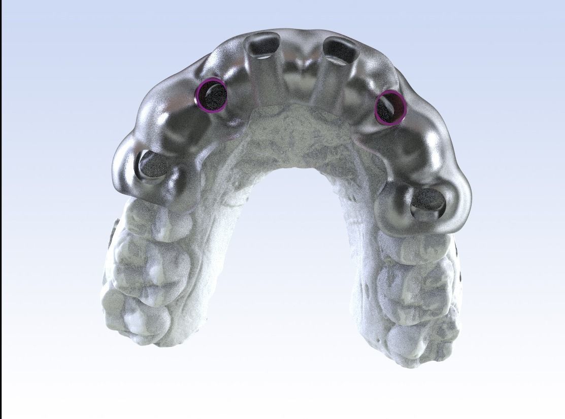 Digital Drilling Guide with Sleeves 3D print model_4