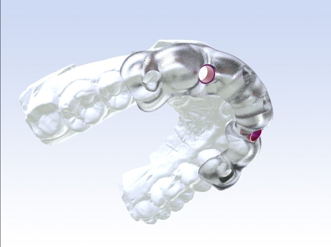 Digital Drilling Guide with Sleeves 3D print model_20