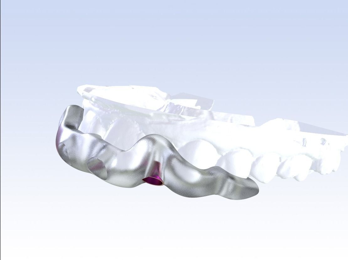 Digital Drilling Guide with Sleeves 3D print model_5