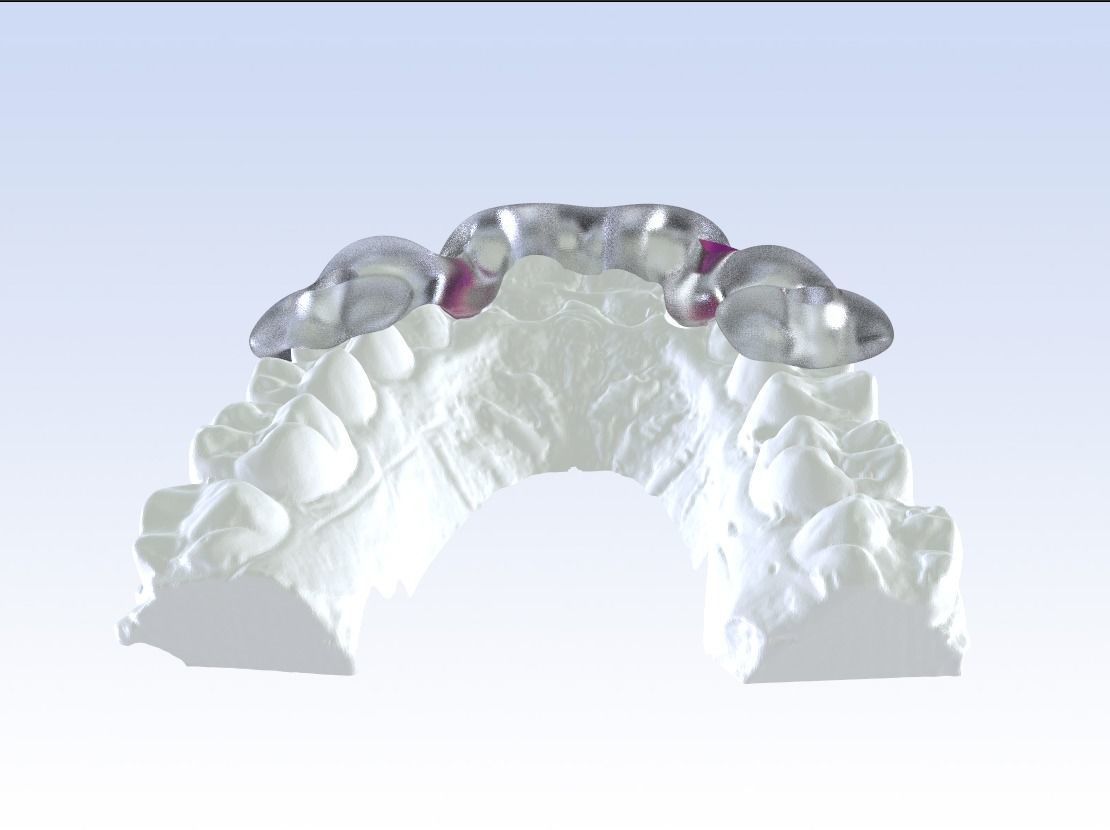 Digital Drilling Guide with Sleeves 3D print model_21