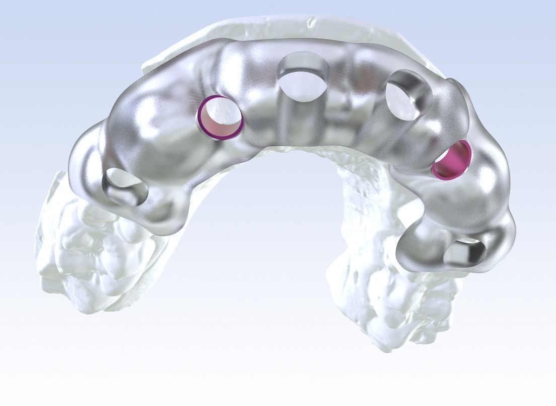 Digital Drilling Guide with Sleeves 3D print model_16