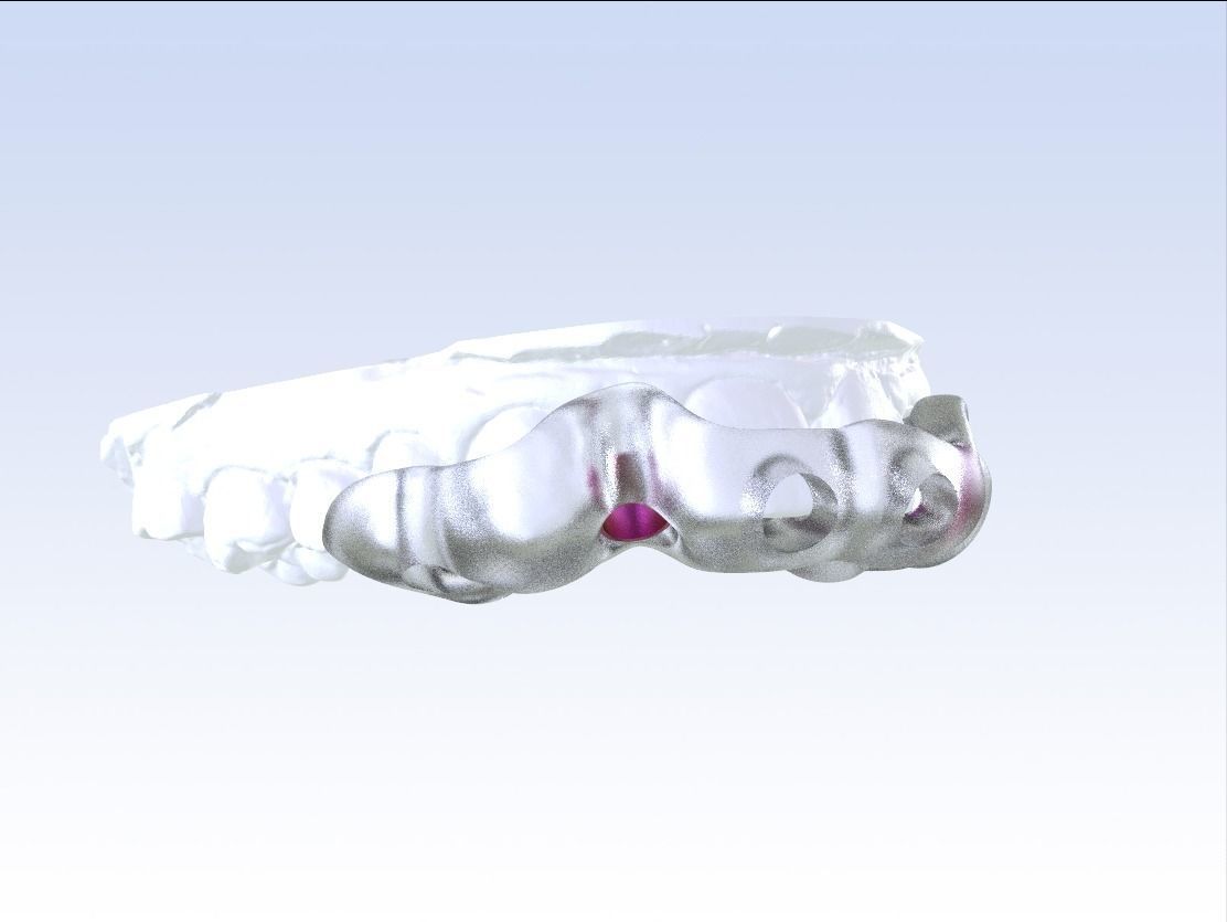 Digital Drilling Guide with Sleeves 3D print model_22