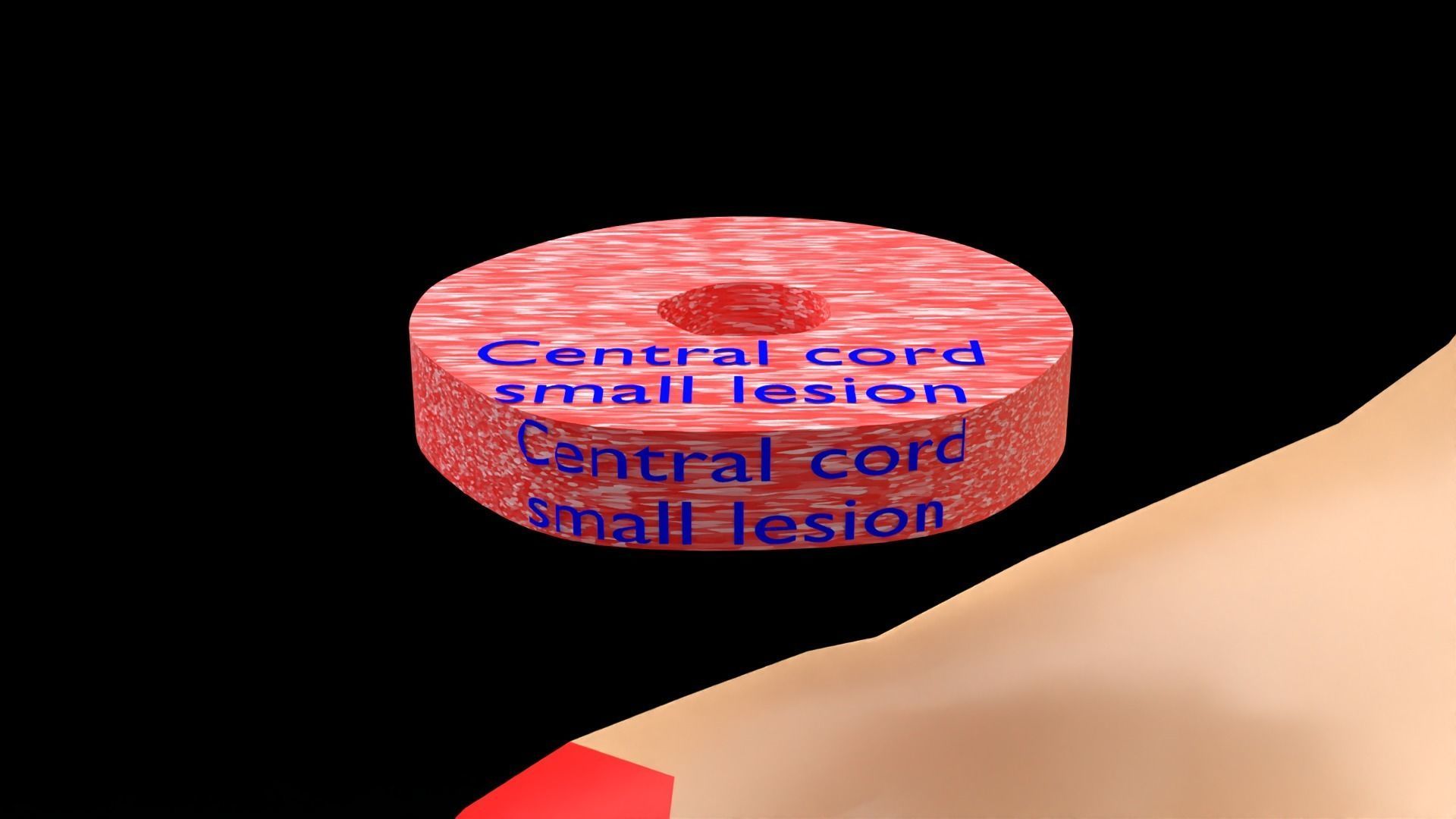 Spinal cord lesions and clinical signs and symptoms 3D model_6