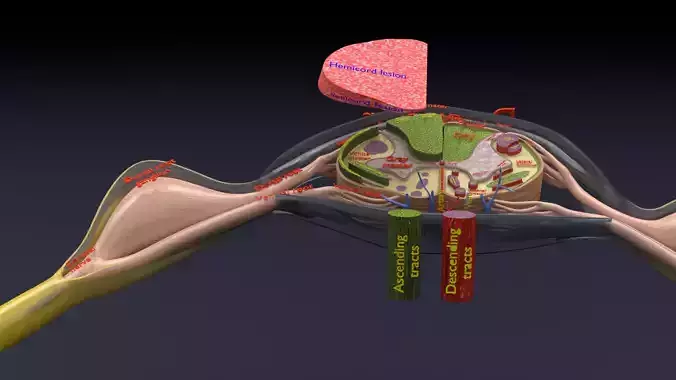 Spinal cord lesions and clinical signs and symptoms 3D model