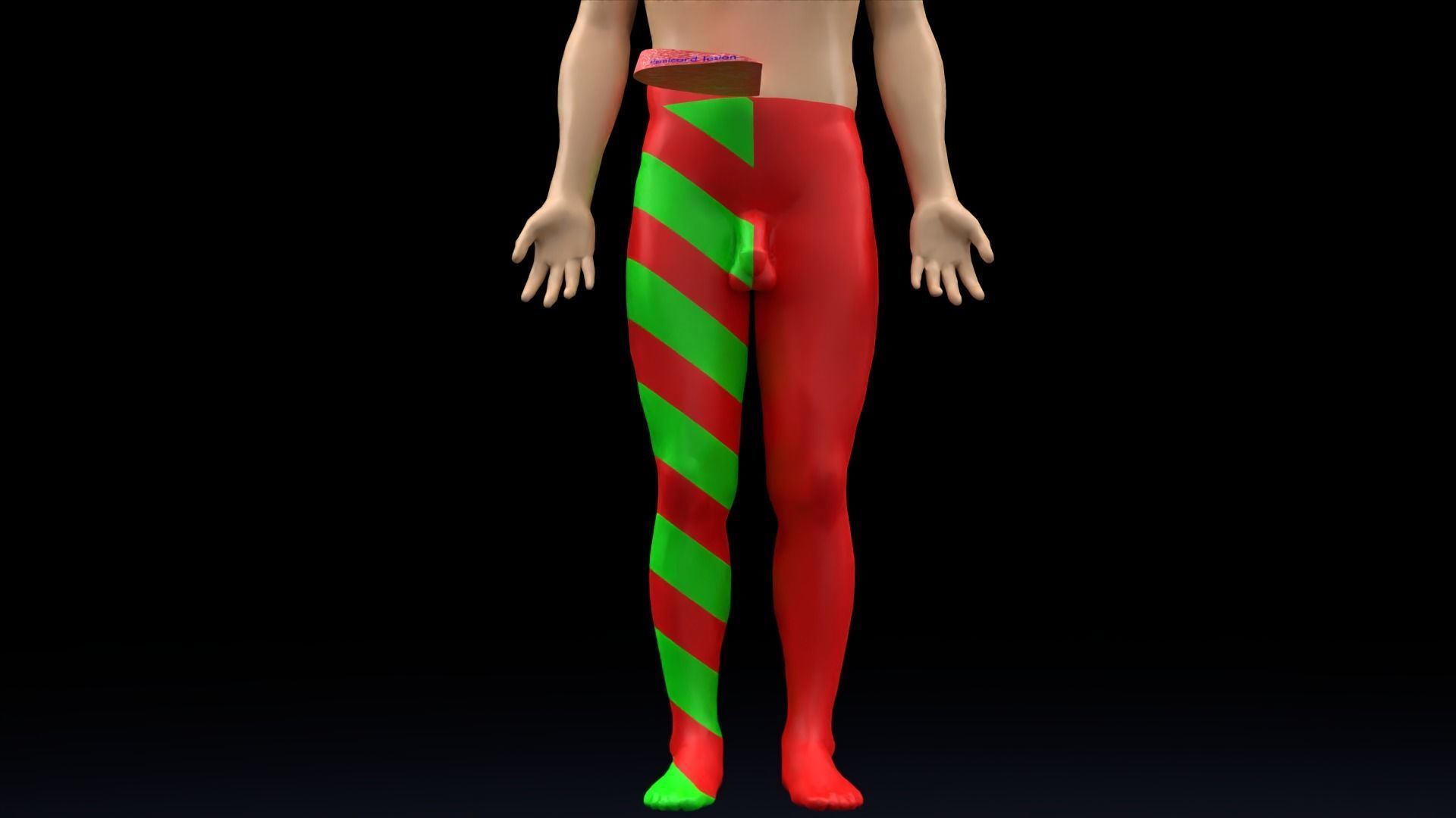 Spinal cord lesions and clinical signs and symptoms 3D model_3