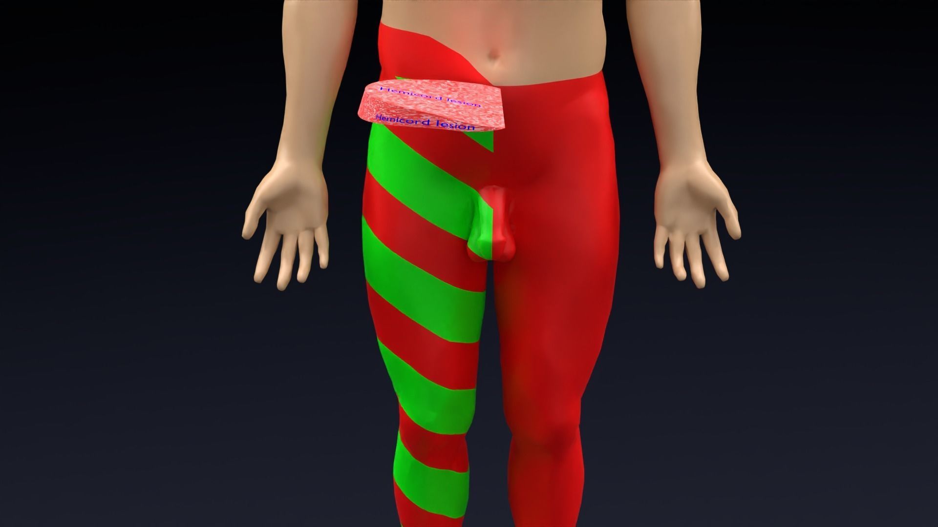 Spinal cord lesions and clinical signs and symptoms 3D model_2