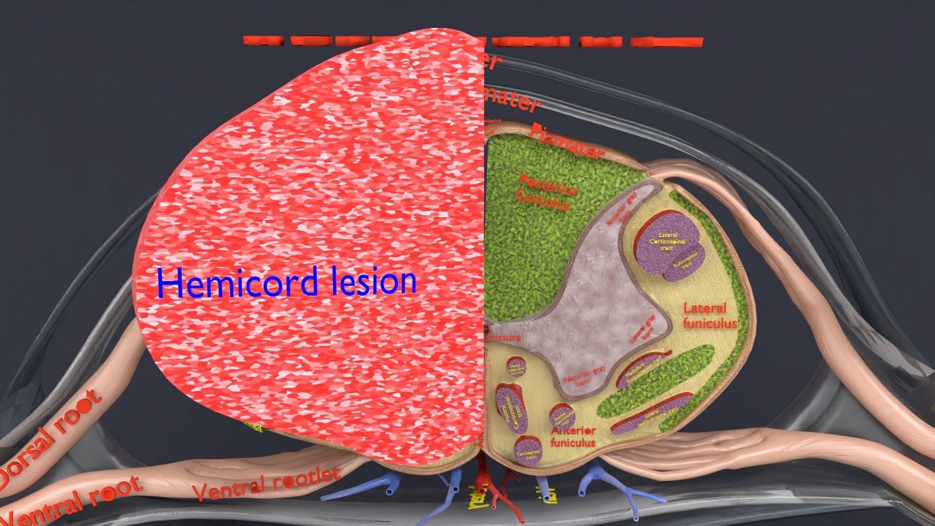Spinal cord lesions and clinical signs and symptoms 3D model_1