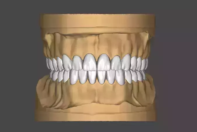 Dental Model in articulator