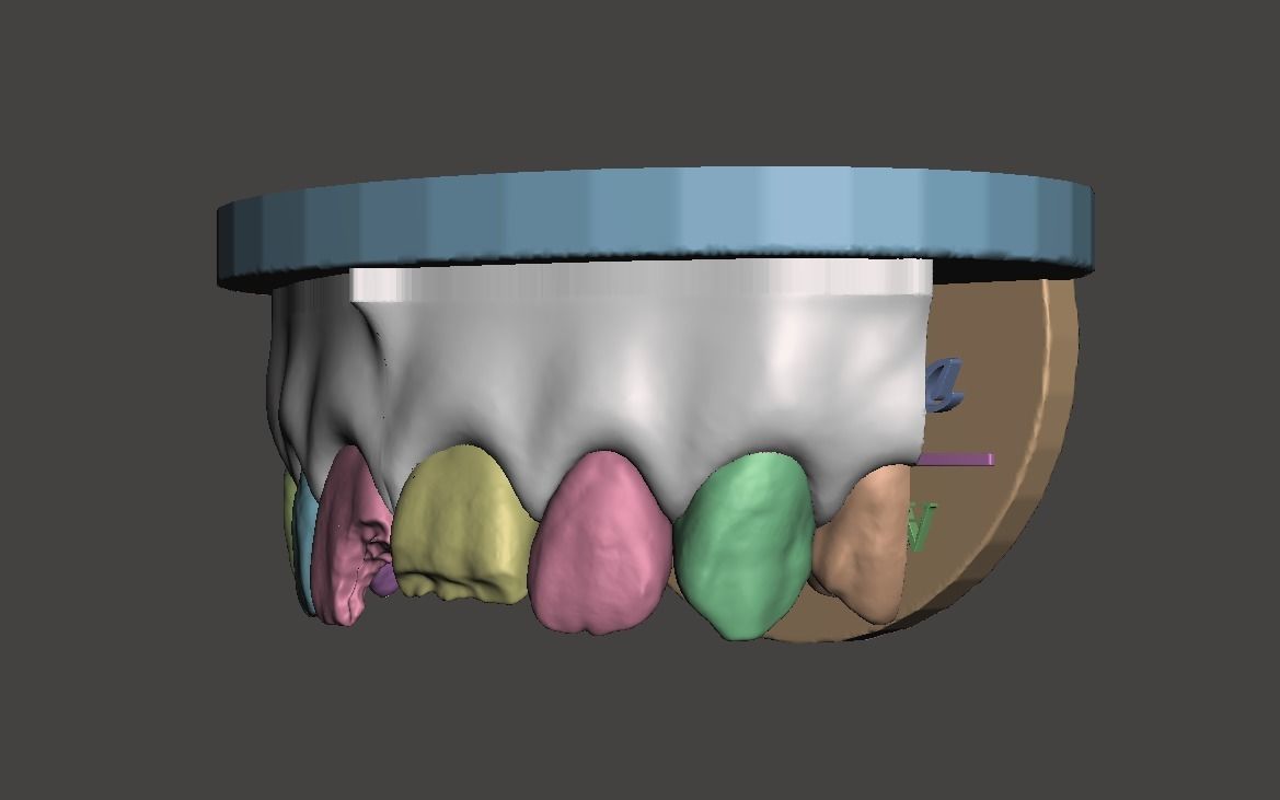 3D Dental Custom Model Anterior Class IV and Class VI Segmented 3D print model_2