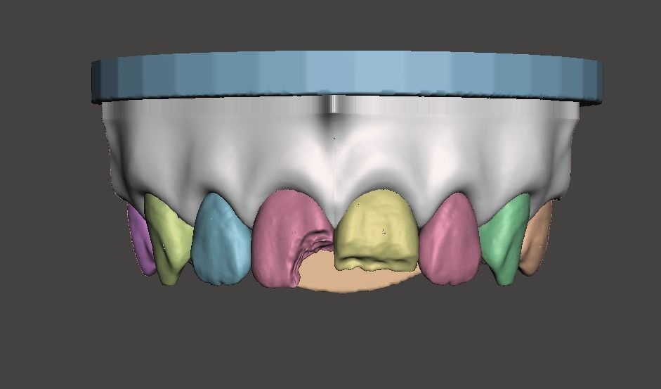3D Dental Custom Model Anterior Class IV and Class VI Segmented 3D print model_1
