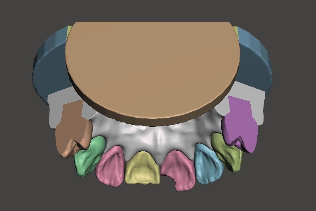 3D Dental Custom Model Anterior Class IV and Class VI Segmented 3D print model_4