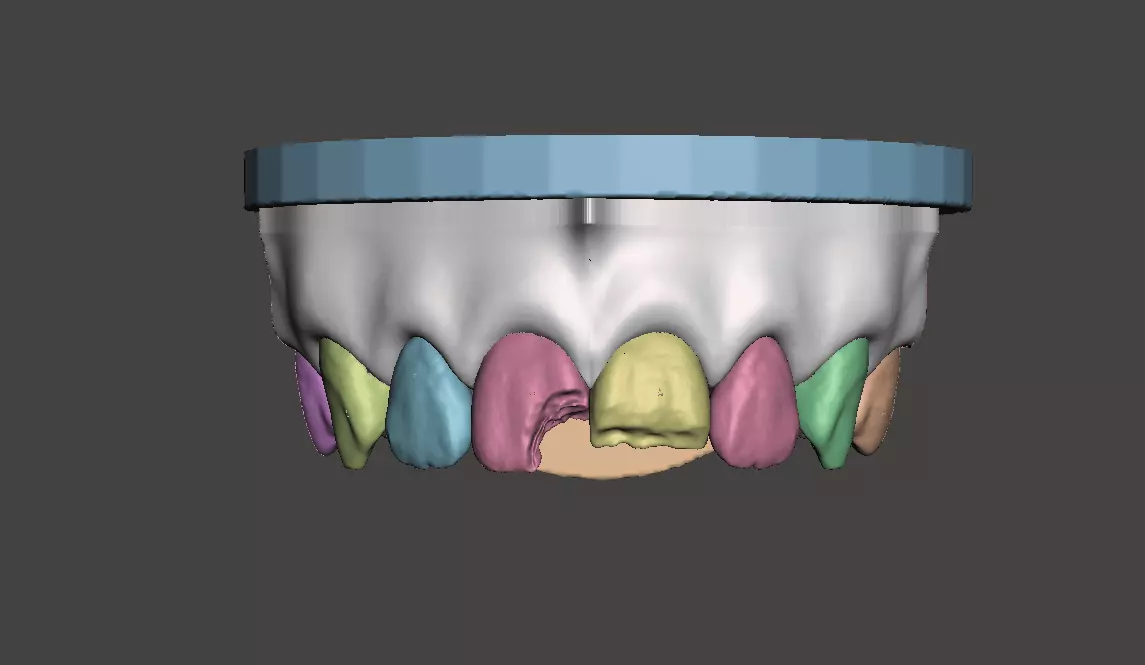 3D Dental Custom Model Anterior Class IV and Class VI Segmented 3D print model_0