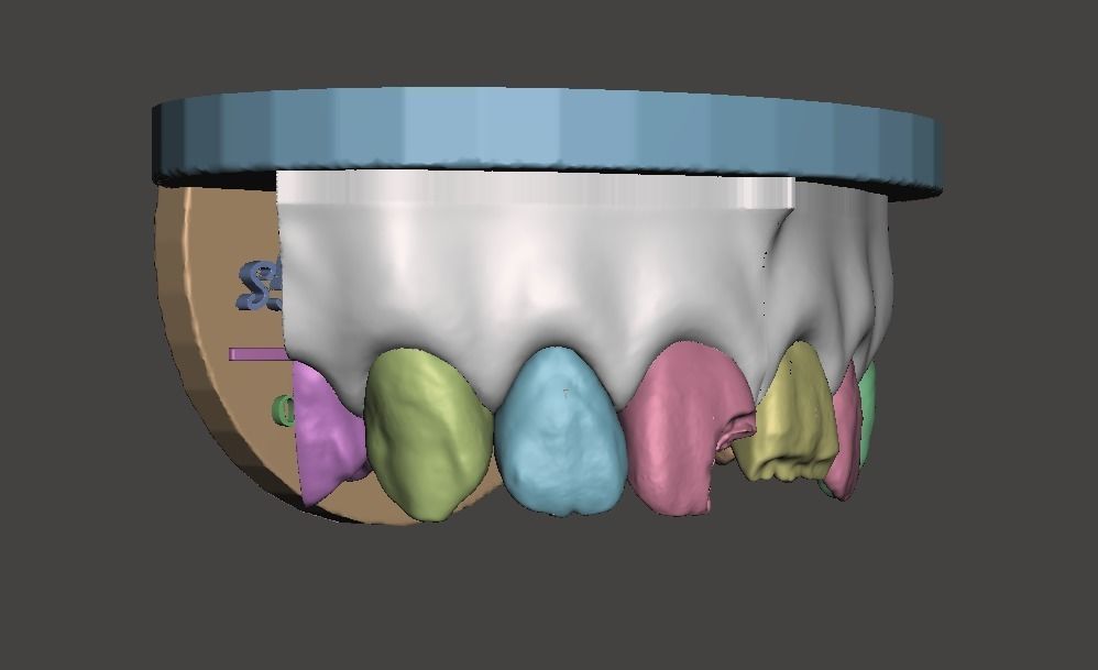 3D Dental Custom Model Anterior Class IV and Class VI Segmented 3D print model_3