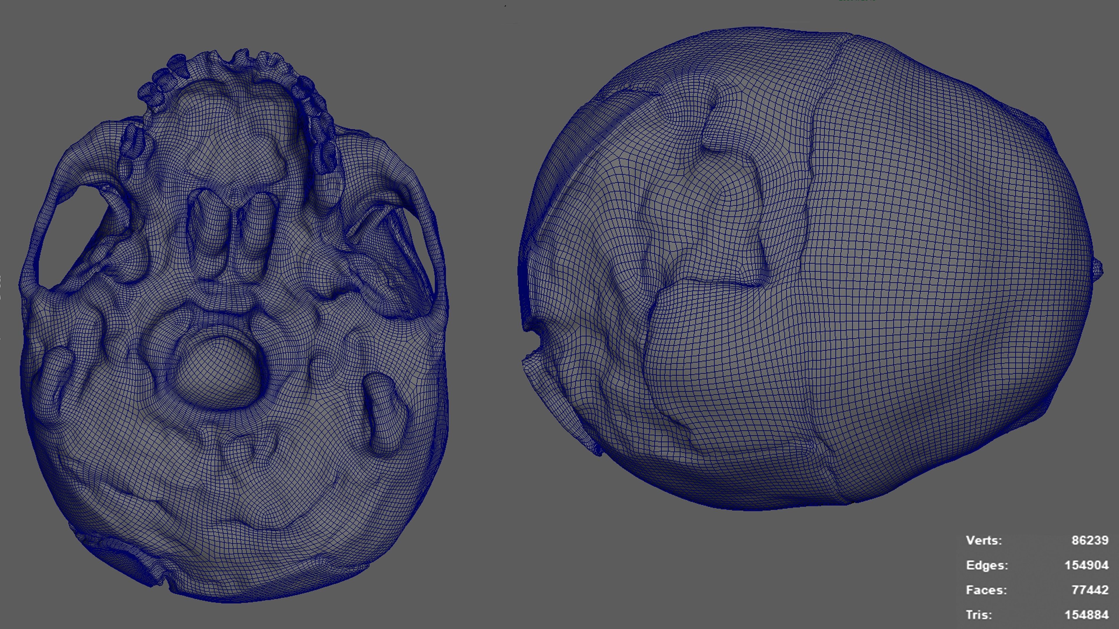 Photorealistic Skull with parietal trauma 3D model_11
