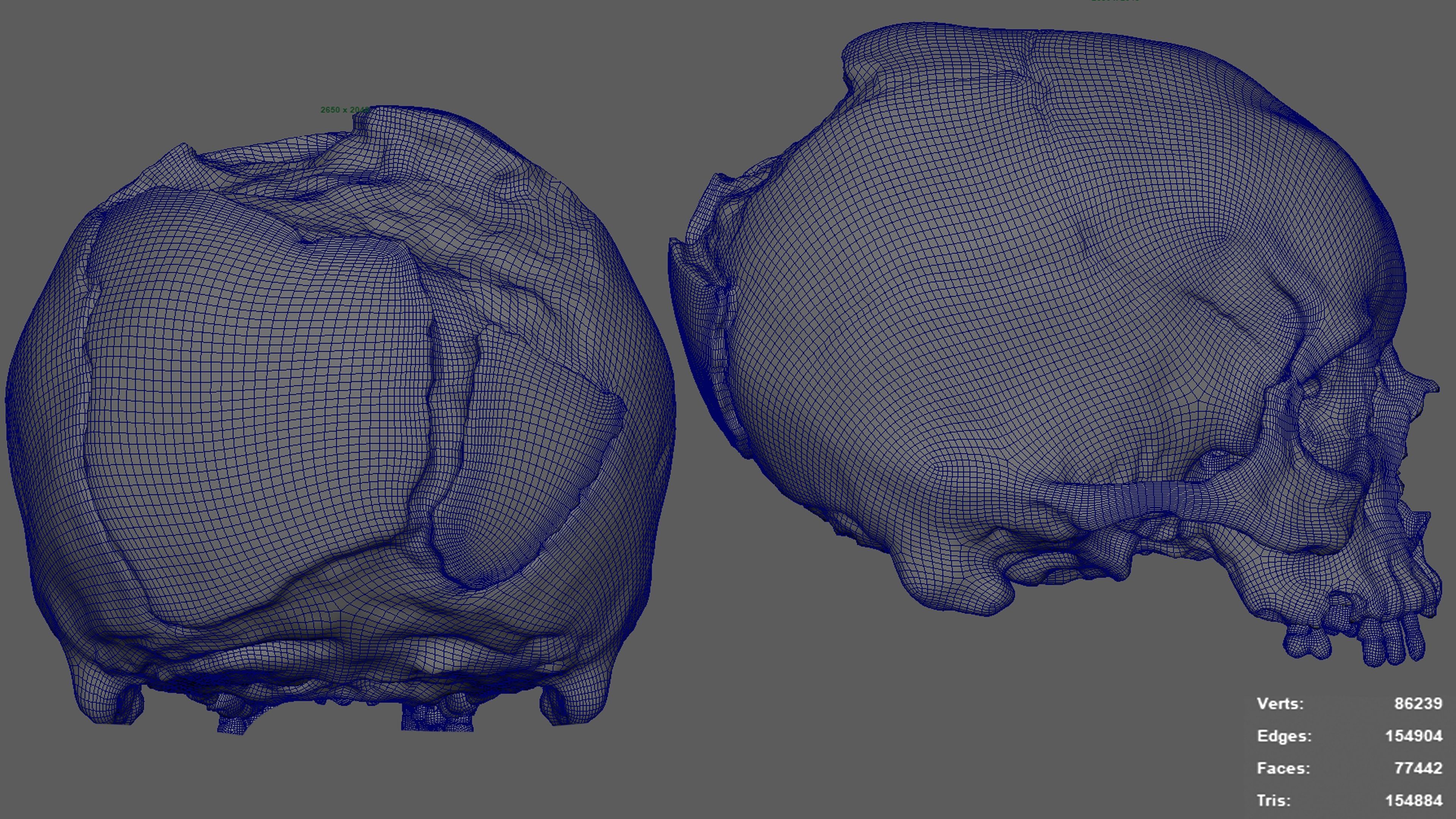 Photorealistic Skull with parietal trauma 3D model_10