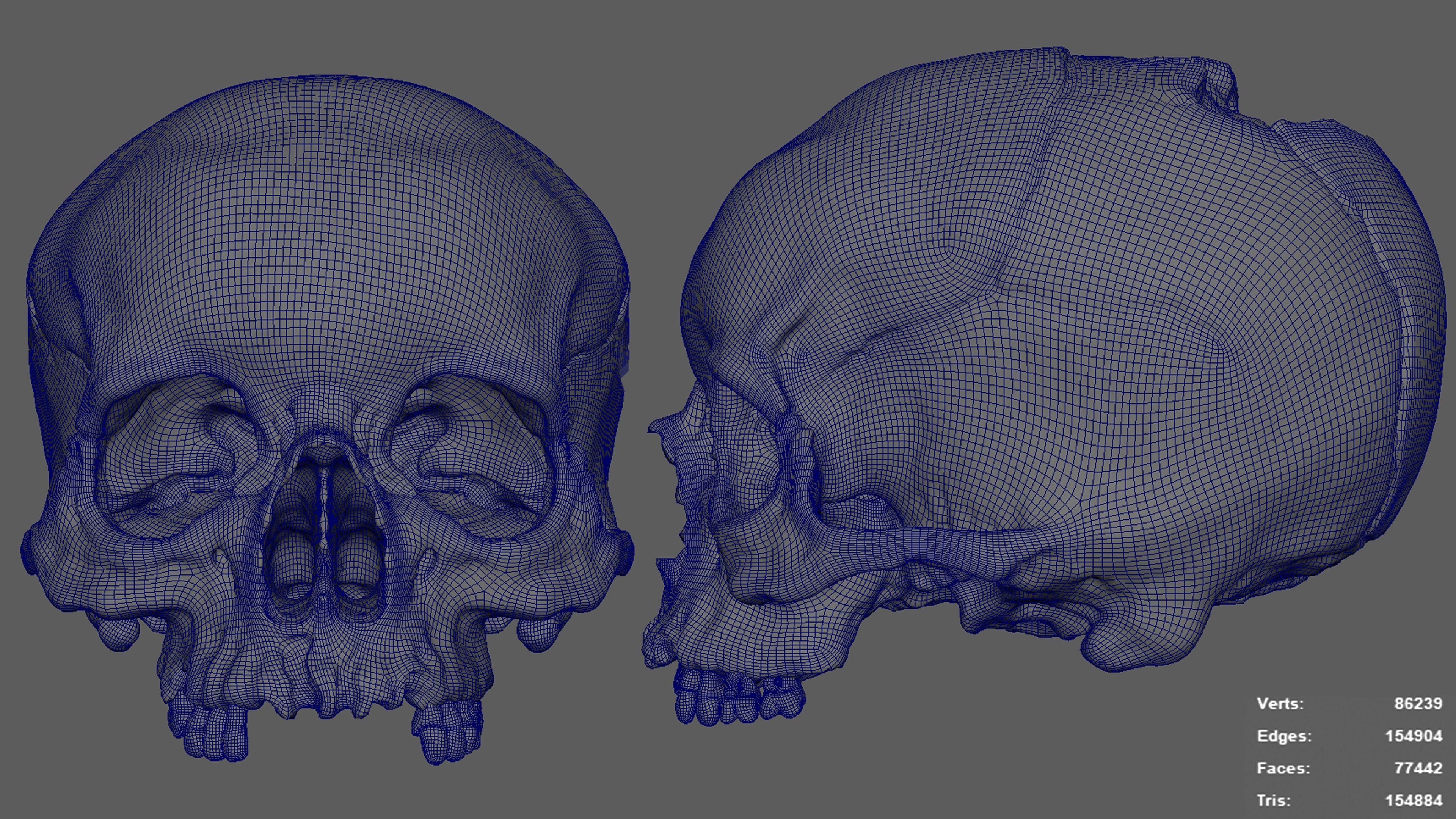 Photorealistic Skull with parietal trauma 3D model_9