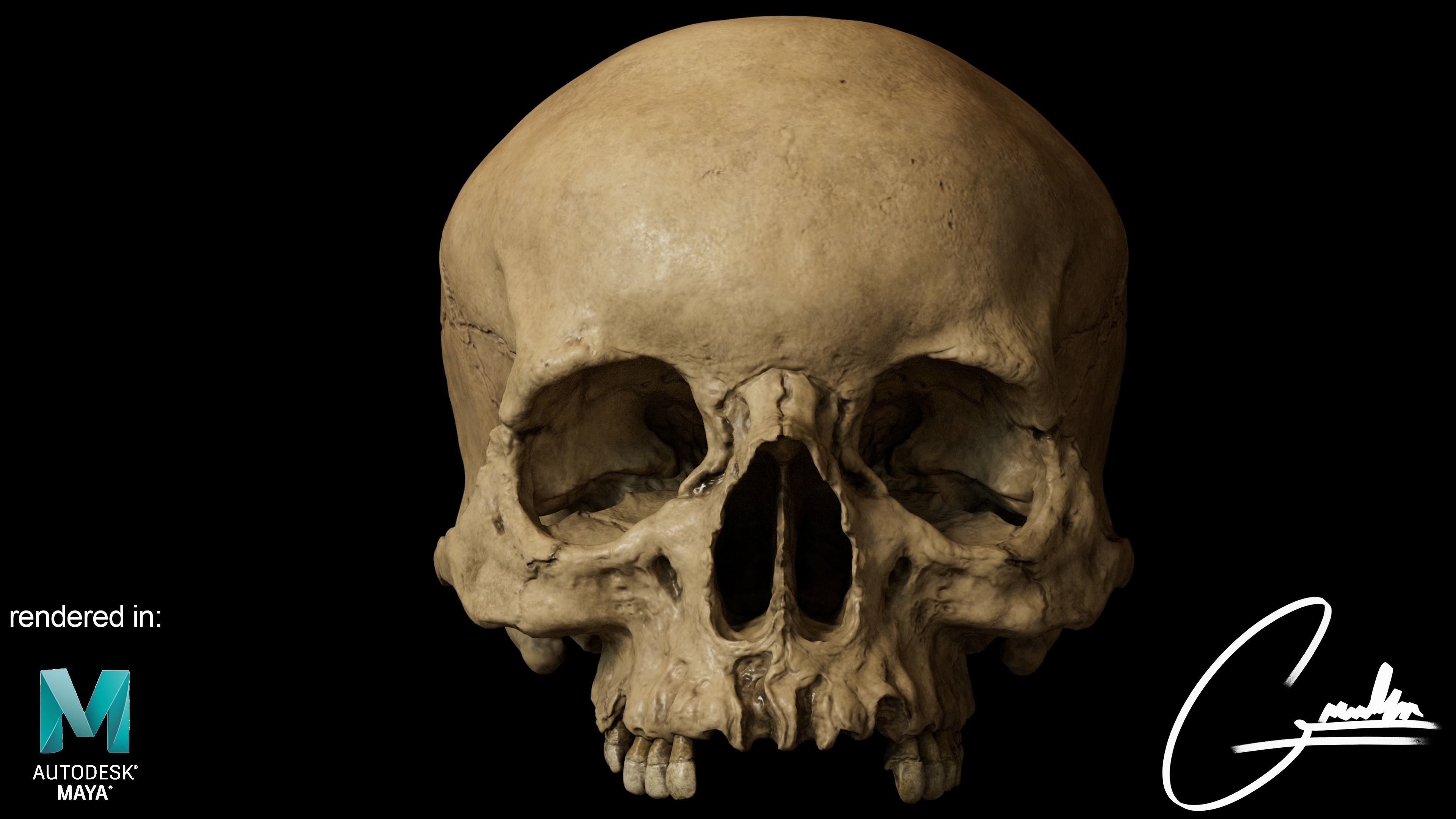 Photorealistic Skull with parietal trauma 3D model_3