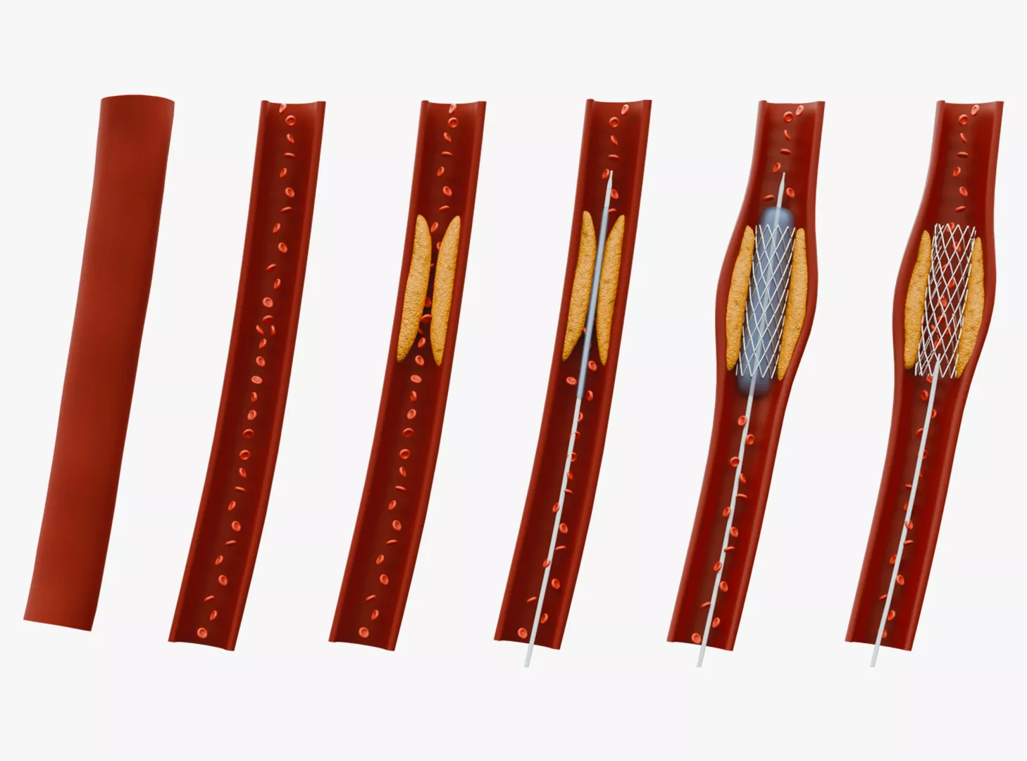Coronary Stent Angioplasty Anatomy - 6 Stage Medical Procedure 3D model