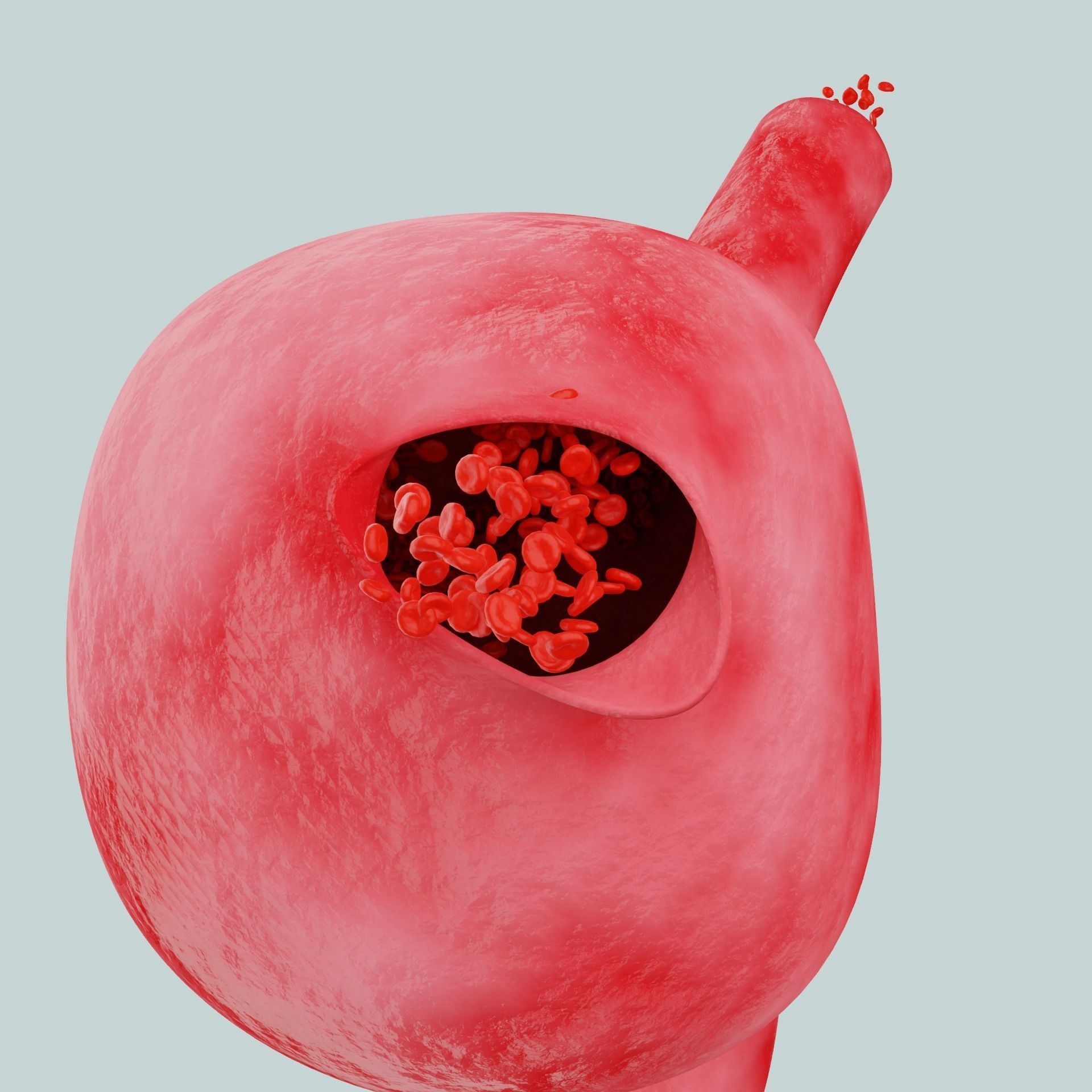 Aneurysm ruptured photorealistic animated  Low-poly 3D model_6