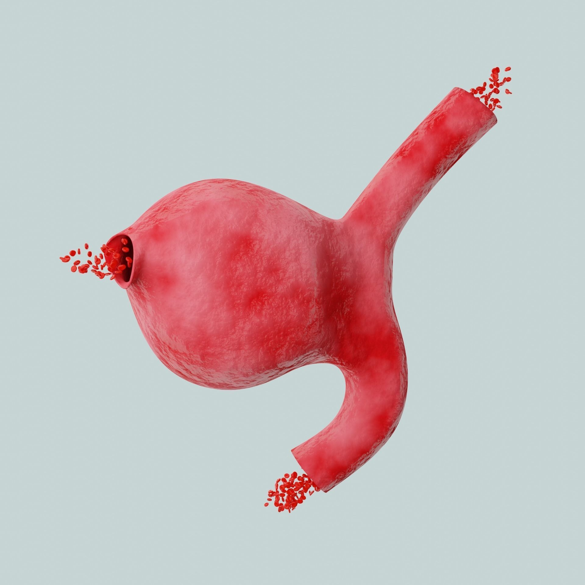 Aneurysm ruptured photorealistic animated  Low-poly 3D model_4