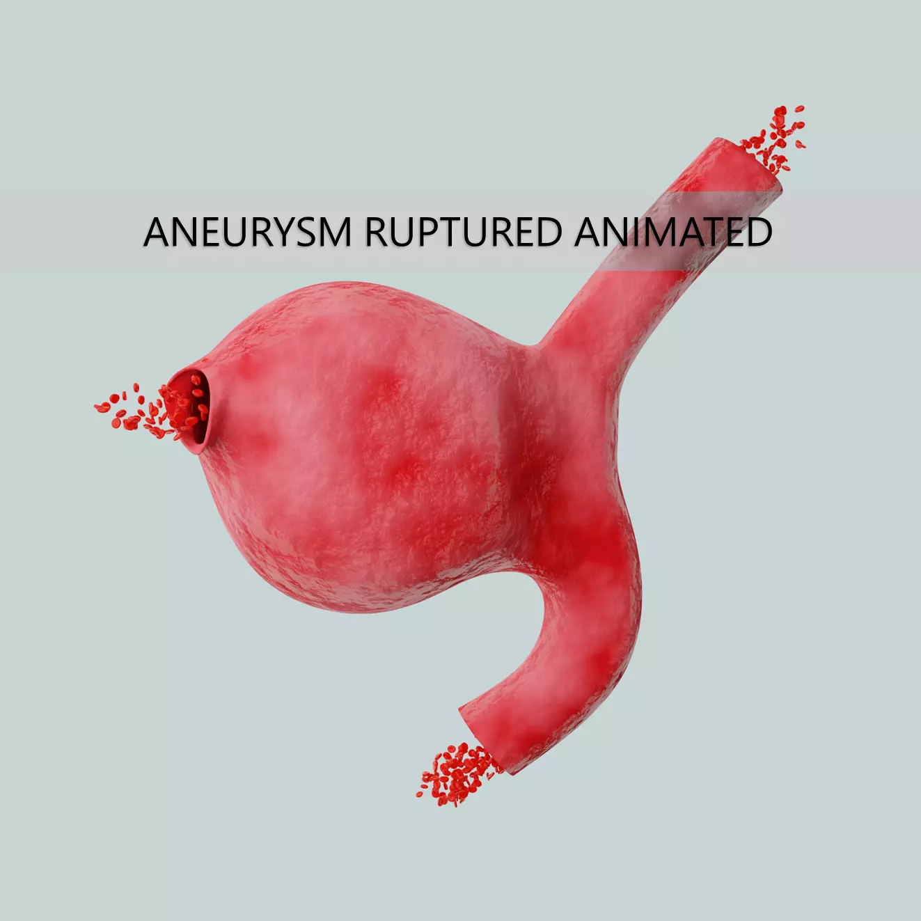 Aneurysm ruptured photorealistic animated  Low-poly 3D model_0
