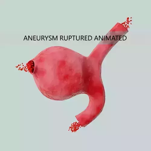 Aneurysm ruptured photorealistic animated  Low-poly 3D model