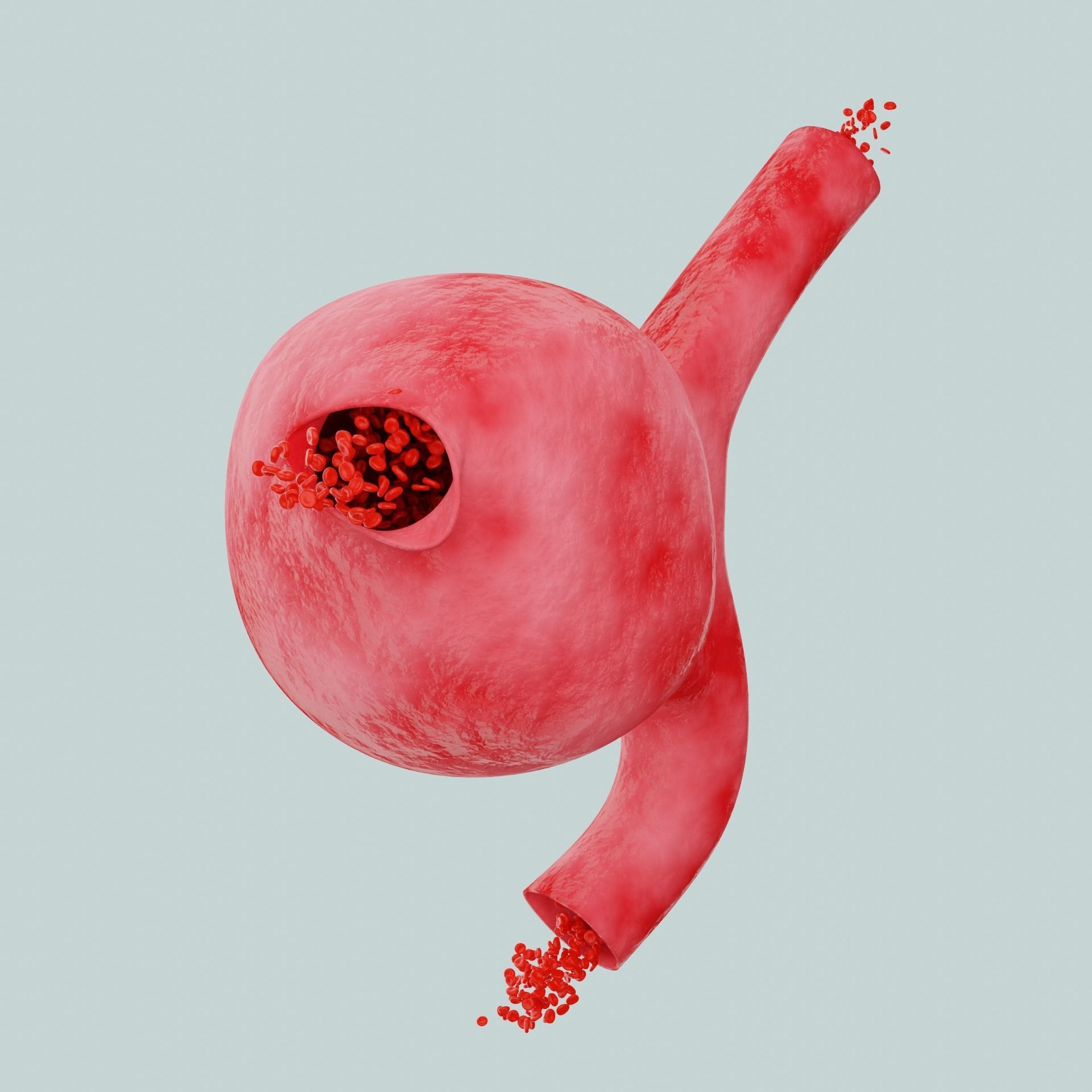 Aneurysm ruptured photorealistic animated  Low-poly 3D model_5