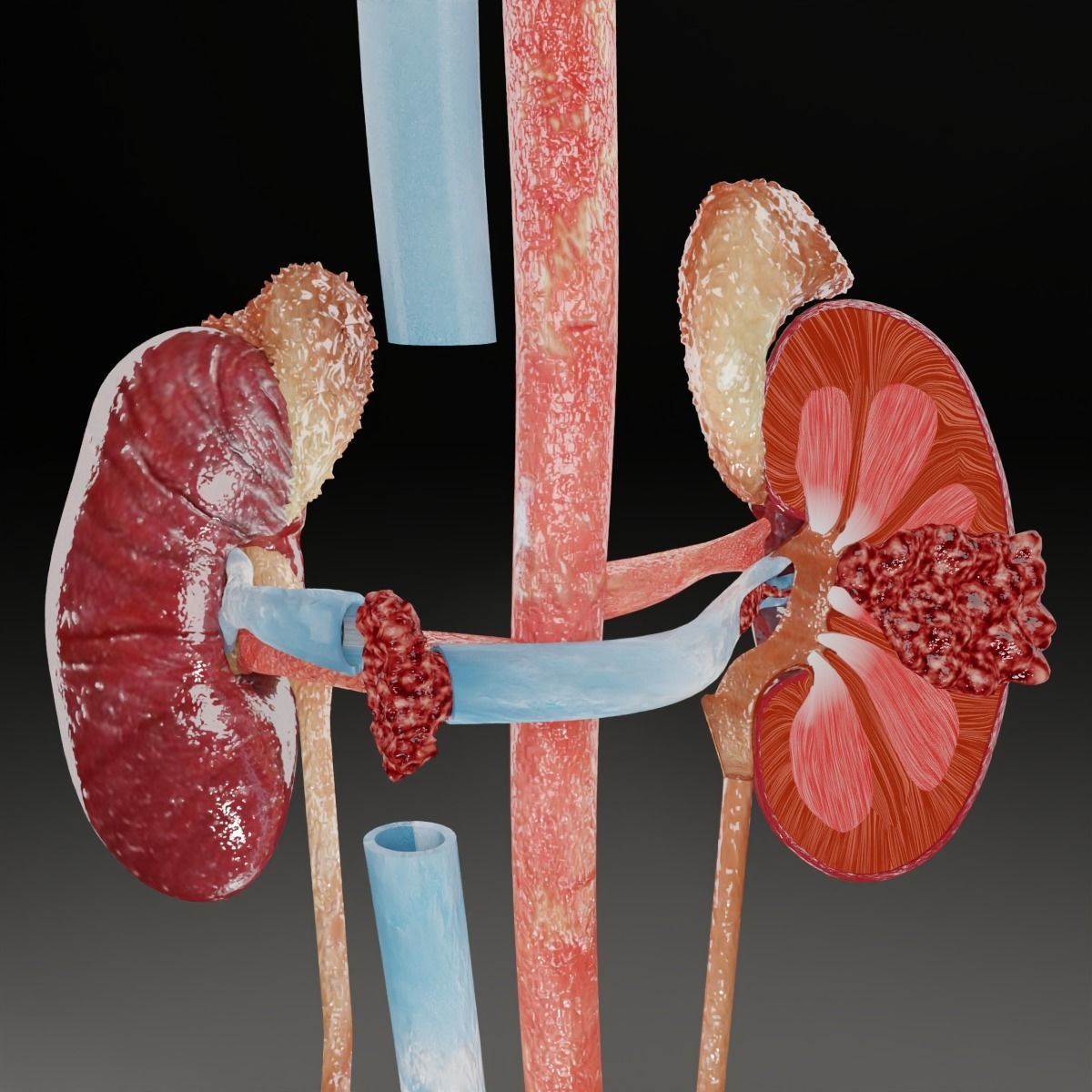 Renal cell carcinoma 3D model_48