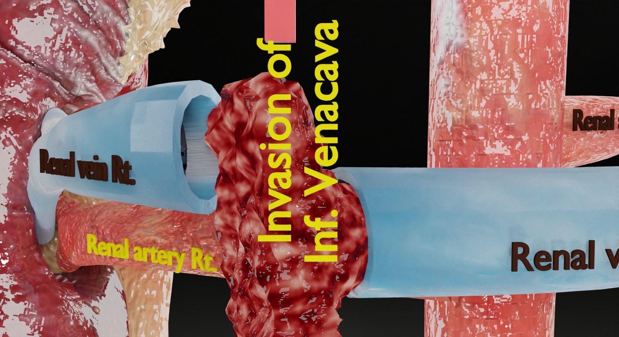 Renal cell carcinoma 3D model_15