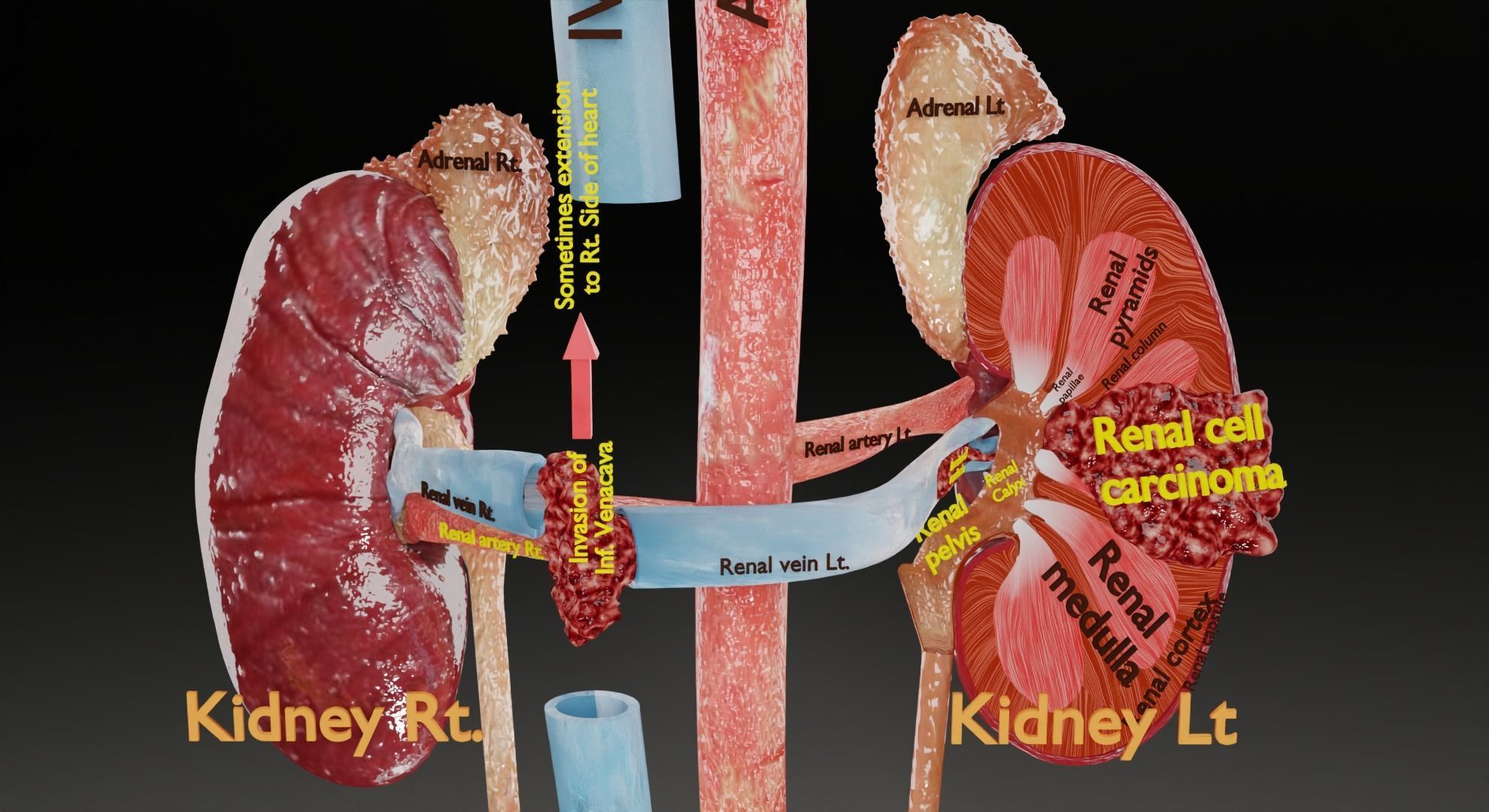 Renal cell carcinoma 3D model_3